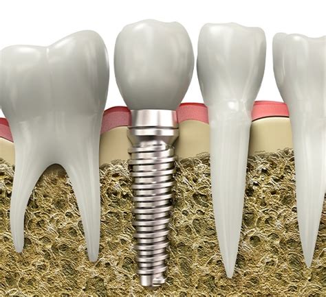 Implant-Retained Crowns North Raleigh | Dr. Philip A. Lisk