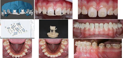 Design And Print Your Own Customized Orthodontic Brackets