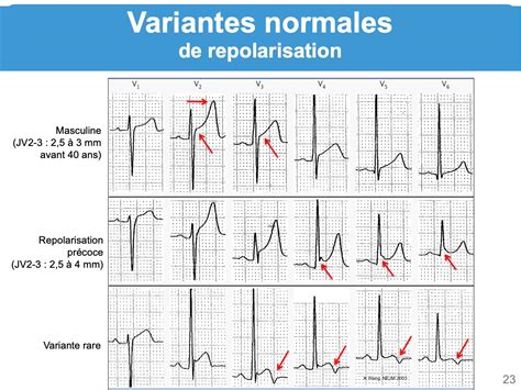 Repolarisation Masculine E Cardiogram