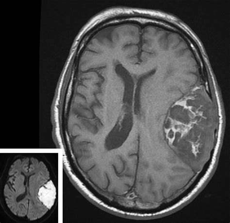 A Tight Squeeze With An Intracranial Epidermoid Brain Tumour The Lancet