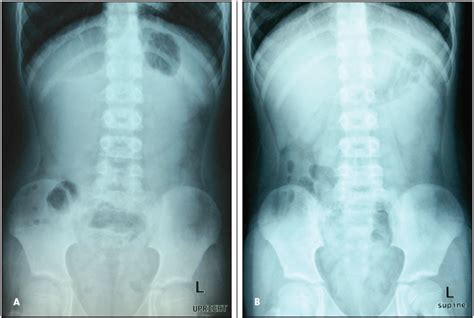 Case In Point An Unusual Case Of Ileal Ileo Intussusception