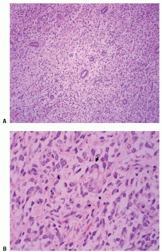 Wilms Tumor Radiology Key