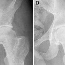 Pdf Hip Arthroscopy For The Management Of Osteoid Osteoma Of The