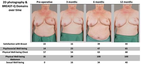 Efficacy Of An External Volume Expansion Device And Autologous Fat