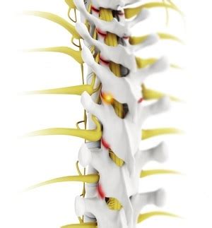 Facet Joint Arthritis Indianapolis | Lumbar Radiculopathy | Spine ...