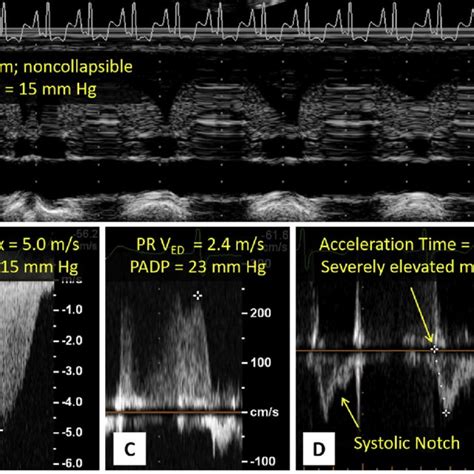 Transthoracic Echocardiography Spectral Doppler Demonstrates Complete