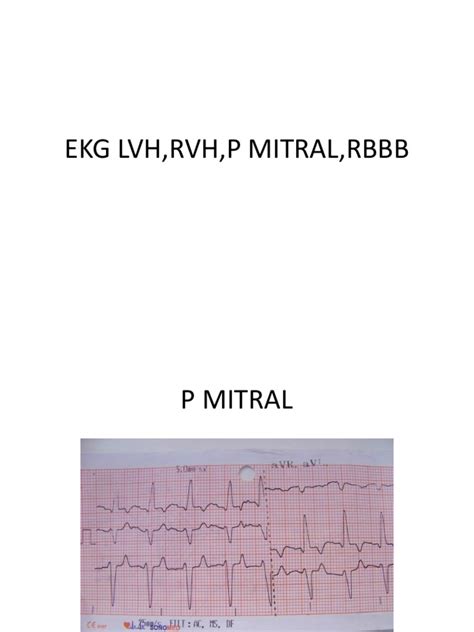 Ekg Lvh Rvh P Mitral Rbbb Pdf