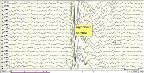 Ictal Eegs Demonstrating The Hz Generalized High Amplitude