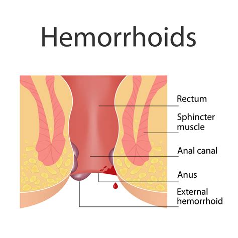 Anus Is Leaking Fluid