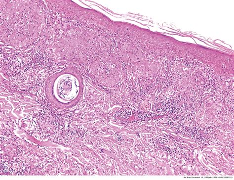 In Vivo Assessment Of A Case Of Cutaneous Sarcoidosis Using Reflectance