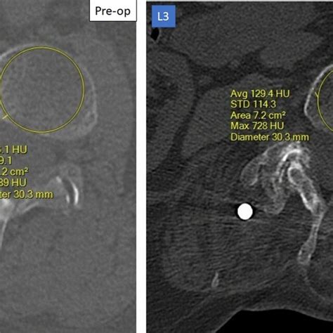 Measure Of Hounsfield Units Off Of A Lumbar Computed Tomography Scan At L2 Download Scientific