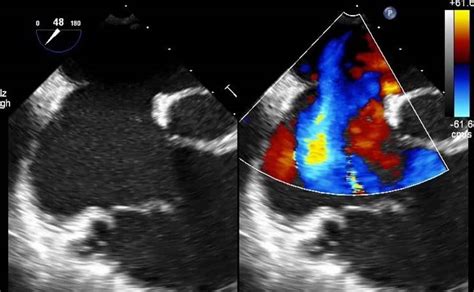 Normal Vs Abnormal Echocardiogram