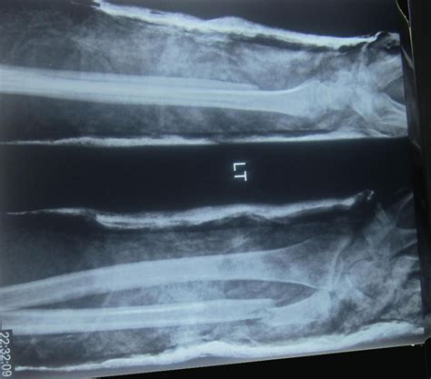 Radius And Ulna Shaft Fracture