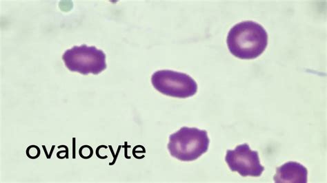 Ovalocytes