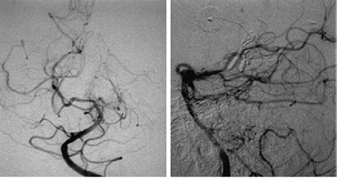 Case 2 Postoperative Left Vertebral Angiograms Anteroposterior Left