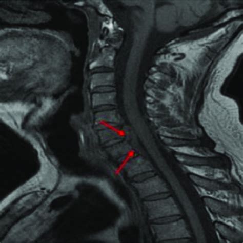 Sagittal Cervical T1 Weighted Magnetic Resonance Imaging Mri Showing