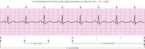 ECG INTERPRETATION FOR NCLEX: PART TWO - The Nurse Speak