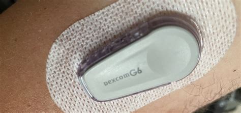 Dexcom G6 – sugarrunner