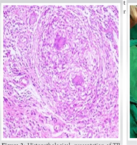 Figure From Knee Tuberculosis Presenting As Pigmented Villonodular