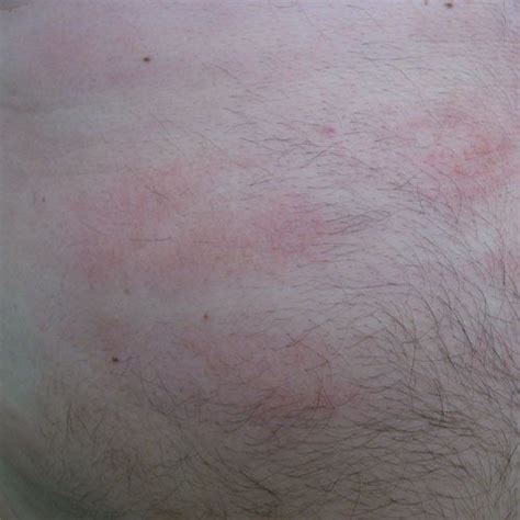 Gallery Of Hives Pictures For Identifying Rashes