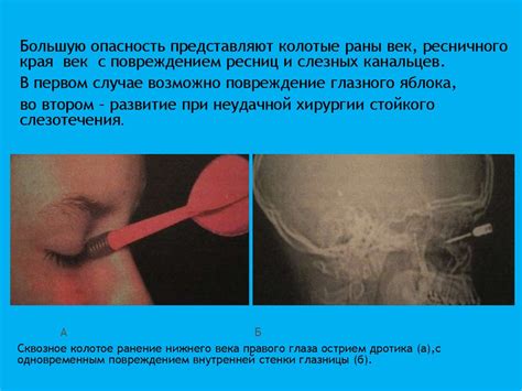 Травмы органа зрения - презентация онлайн
