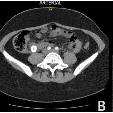 Axial Contrasted Computed Tomography Of The Abdomen A Topogram