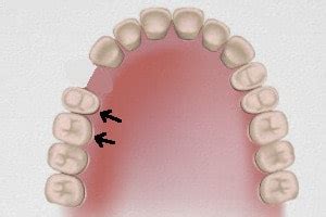 What is a Cantilever Dental Bridge?