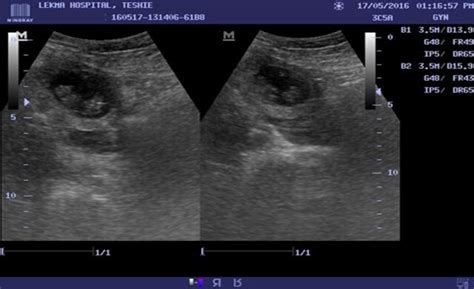 Pelvic Ultrasound images demonstrating a gestational sac with two ...