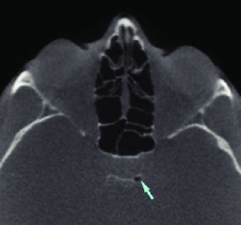 Posterior Clinoid Process Pneumatization On The Left Side Download Scientific Diagram