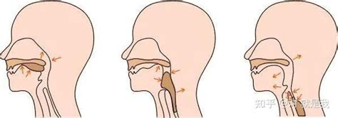 实用 关于吞咽障碍的康复训练 知乎