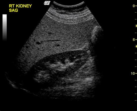 Liver Pathology Ultrasound Flashcards Quizlet