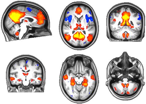 Frontiers Structural And Functional Reorganization Of The Brain In