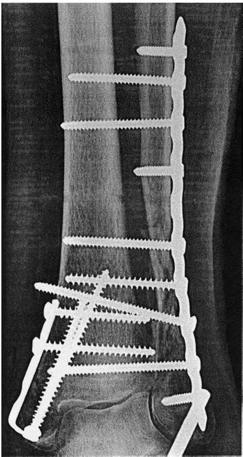 Distal Tibial And Fibular Fractures TeachMe Orthopedics