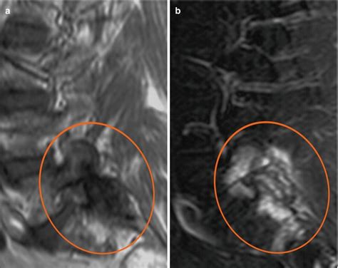 Facet Joint Arthropathy Mri