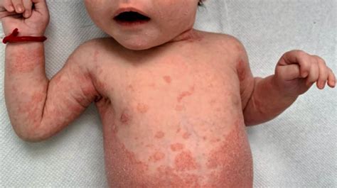 Baby Psoriasis Appearance Diagnosis And Management