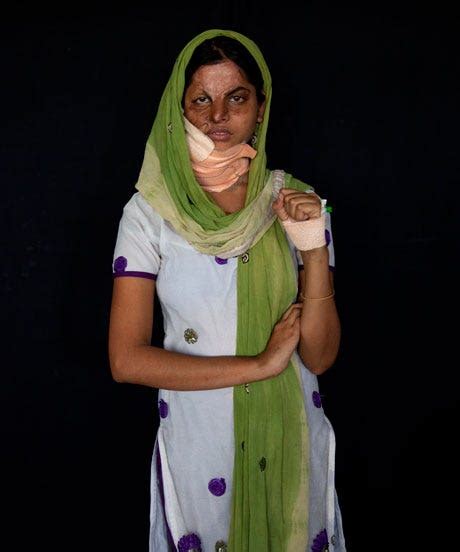 Acid Attack Survivors Striking Photos