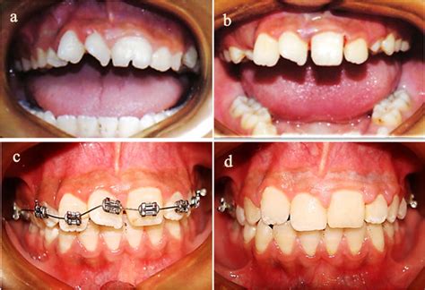 Intraoral Photographs A Pretreatment Intraoral Photograph Showing