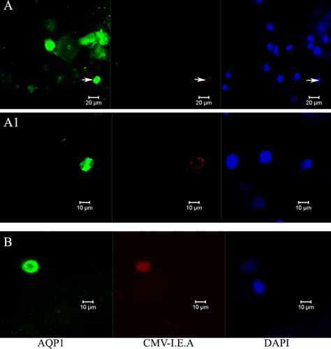 Confocal Immunofluorescence Staining Of Urinary Sediment For