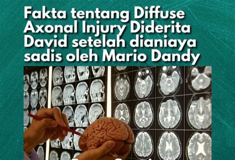 Apa Itu Diffuse Axonal Injury Yang Dialami Crystalino David Ozora Kader