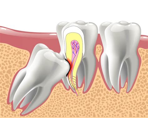 Wisdom Teeth Piedmont Dental Associates