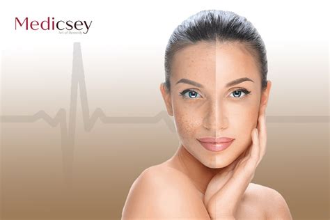 Laser Skin Rejuvenation In Turkey