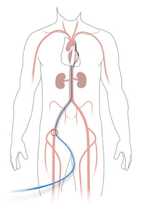 Endovascular Thoracic Aortic Stent Grafting | Stony Brook University ...