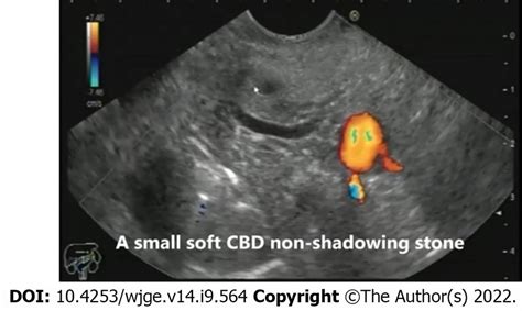 A Small Soft Non Shadowing Common Bile Duct Stone As Seen From The Bulb