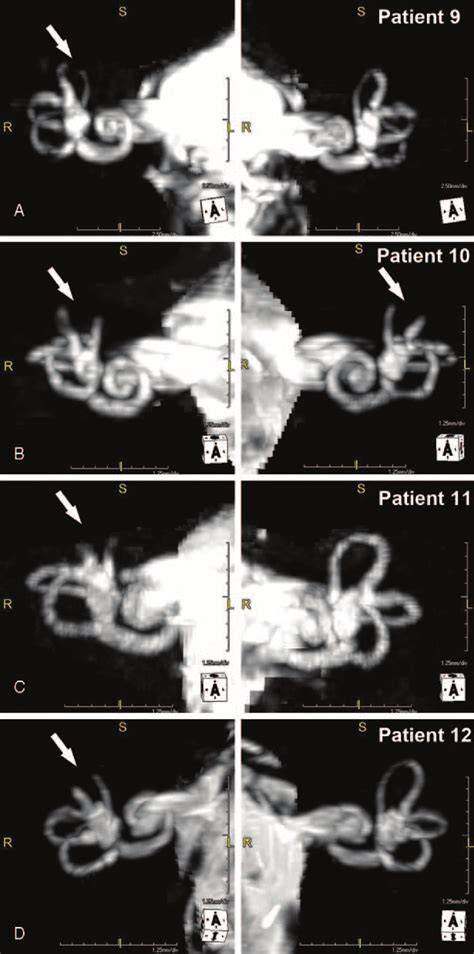 Mri With Ciss Sequences After The Recurrence Of Otic Capsule Dehiscence Download Scientific