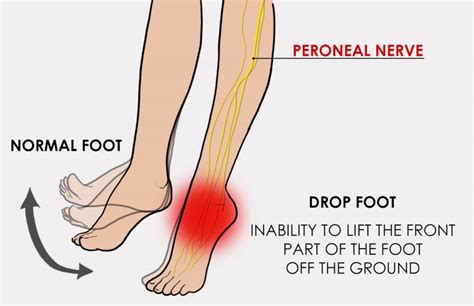 Foot Drop The Foot And Ankle Clinic