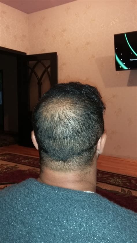 Minoxidil Results Before After Amazing Pictures