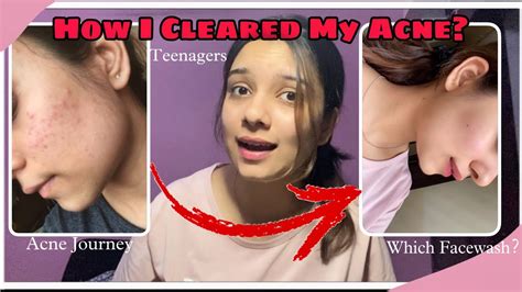 How I Cleared My Acne Just One Product Teenagers🫶🏻 Glowy Skin Youtube