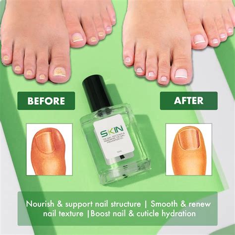 Skinapeel Toe Nail Softener And Ingrown Toenail Treatment Oil