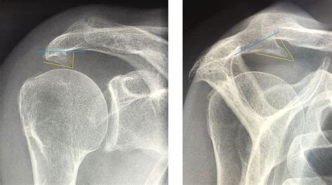 Traitement Du Conflit Sous Acromial Versailles Chirurgie De L