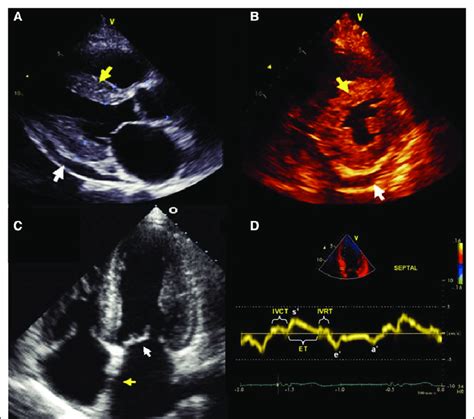 Characteristic Appearance Of Cardiac Amyloidosis On Echocardiography